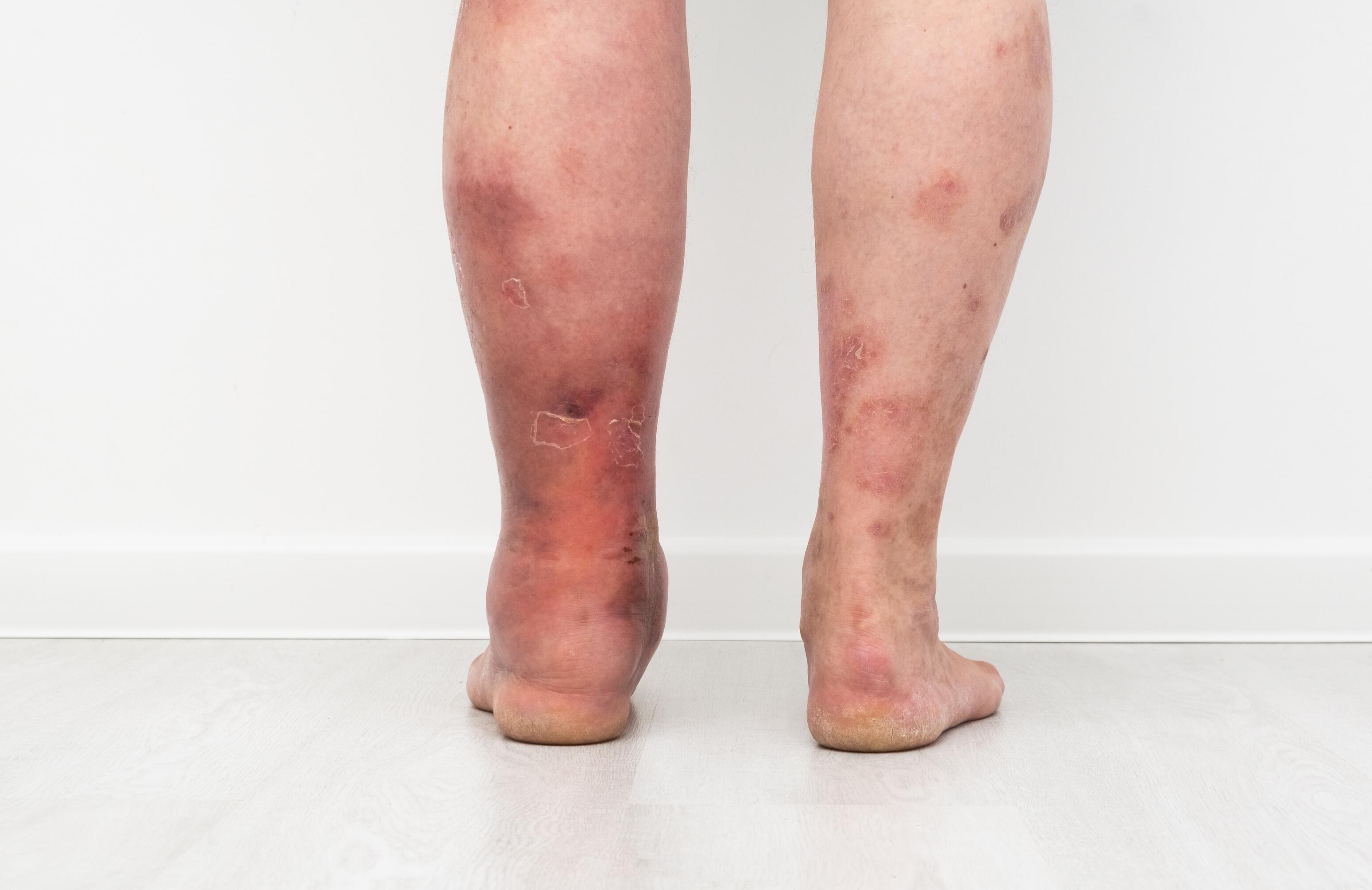 Legs with red patches due to varicose eczema